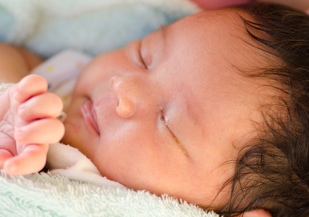 Mata Bayi Belekan, Apakah Berbahaya untuk Bayi?